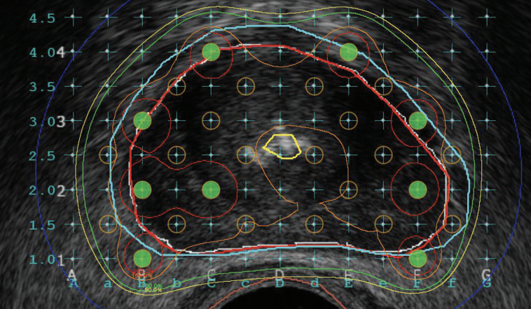 Prostate Texas Radiotherapy